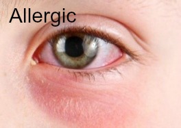Conjunctivitis Allergic A
